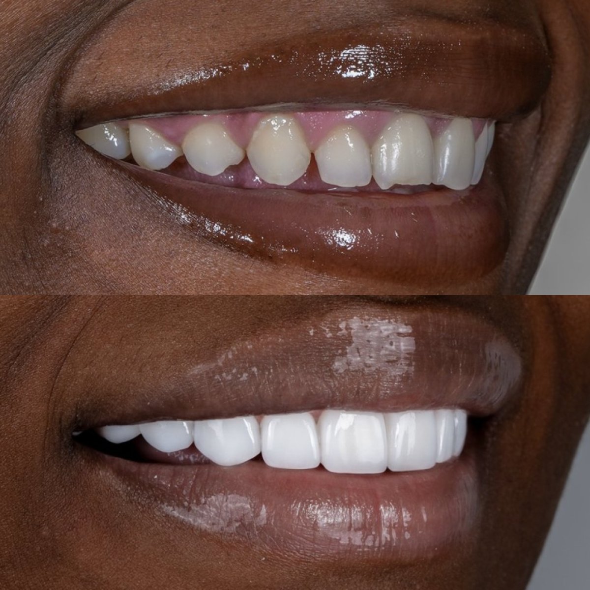 До та після встановлення зубних коронок у Darya Dental Turkey, результат посмішки