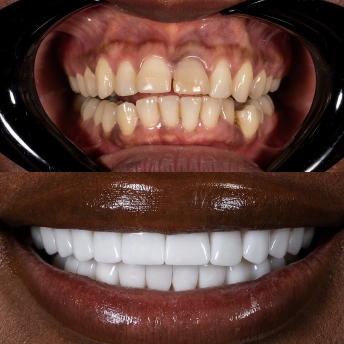 قبل وبعد تركيب تيجان الأسنان في Darya Dental Turkey، نتيجة تحول الابتسامة
