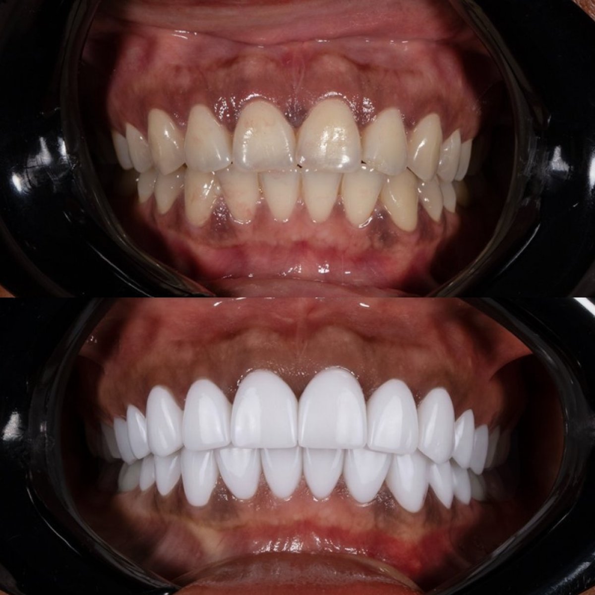 نتائج قبل وبعد تركيب تيجان الأسنان في Darya Dental Turkey، تحول واضح للابتسامة