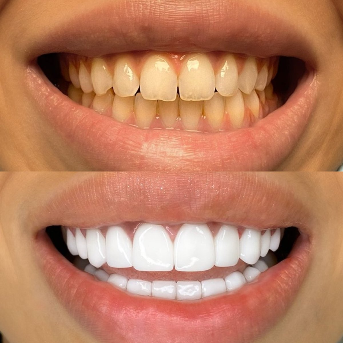 قبل وبعد الفينير في عيادة Darya Dental Turkey – تحول الابتسامة ونتيجة أسنان أكثر بياضًا