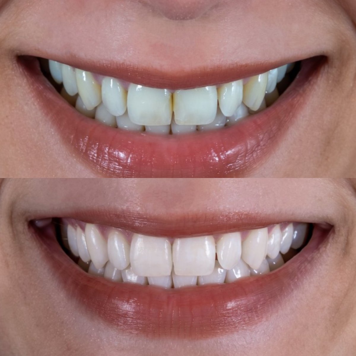 Результаты до и после отбеливания зубов в Darya Dental Turkey, заметно белее улыбка
