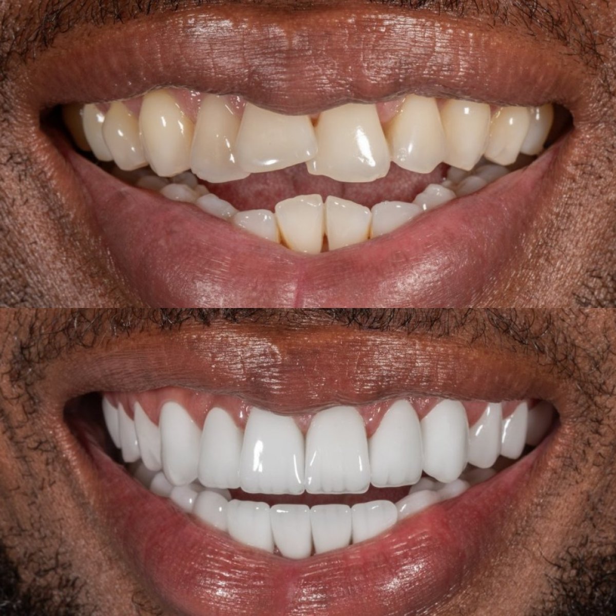 نتائج قبل وبعد تركيب تيجان الأسنان في عيادة Darya Dental Turkey، تحسين الابتسامة