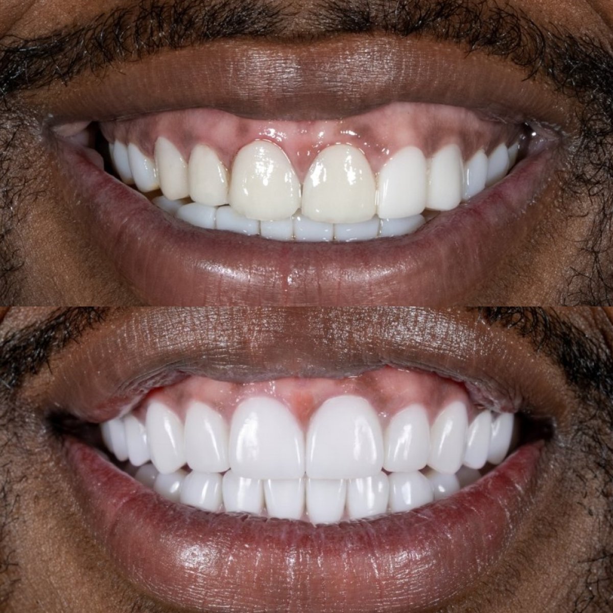 نتائج قبل وبعد تركيب تيجان الأسنان في Darya Dental Turkey، تحسين جمالية الابتسامة