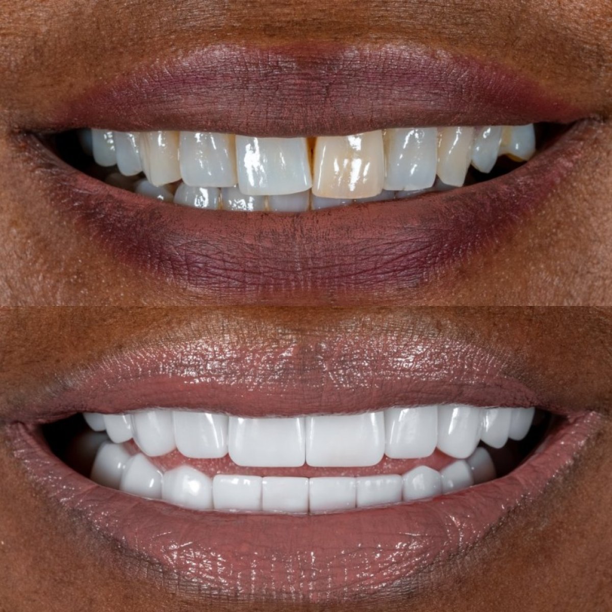 نتائج قبل وبعد تركيب تيجان الأسنان في عيادة Darya Dental Turkey، تحسين مظهر الابتسامة