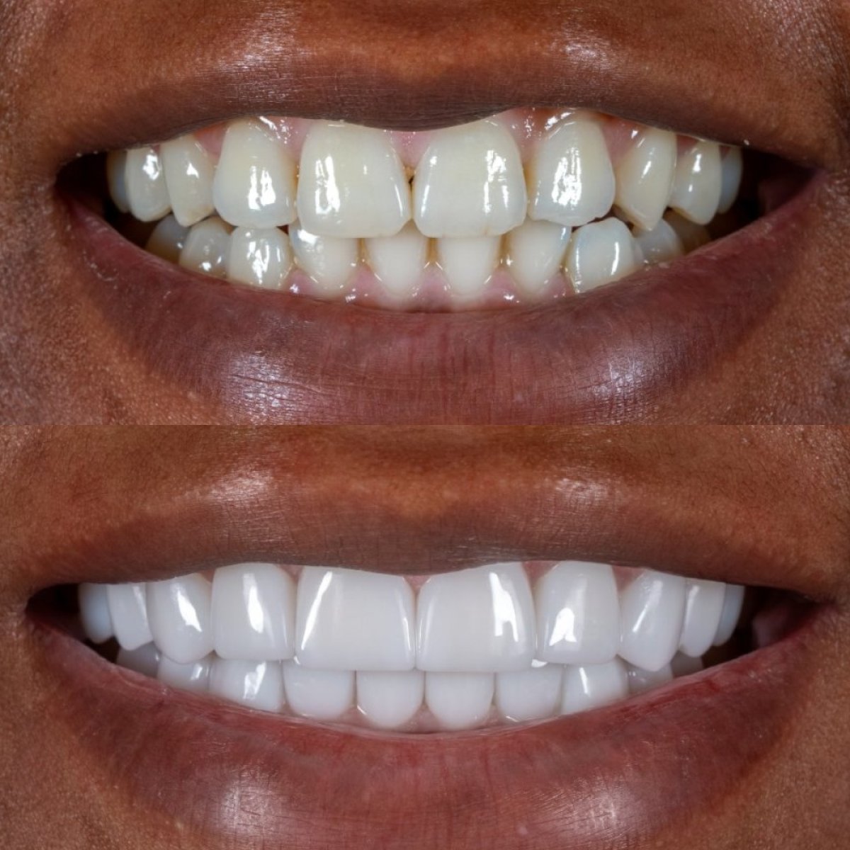 نتائج قبل وبعد تركيب تيجان الأسنان في Darya Dental Turkey، تحسين مظهر الابتسامة