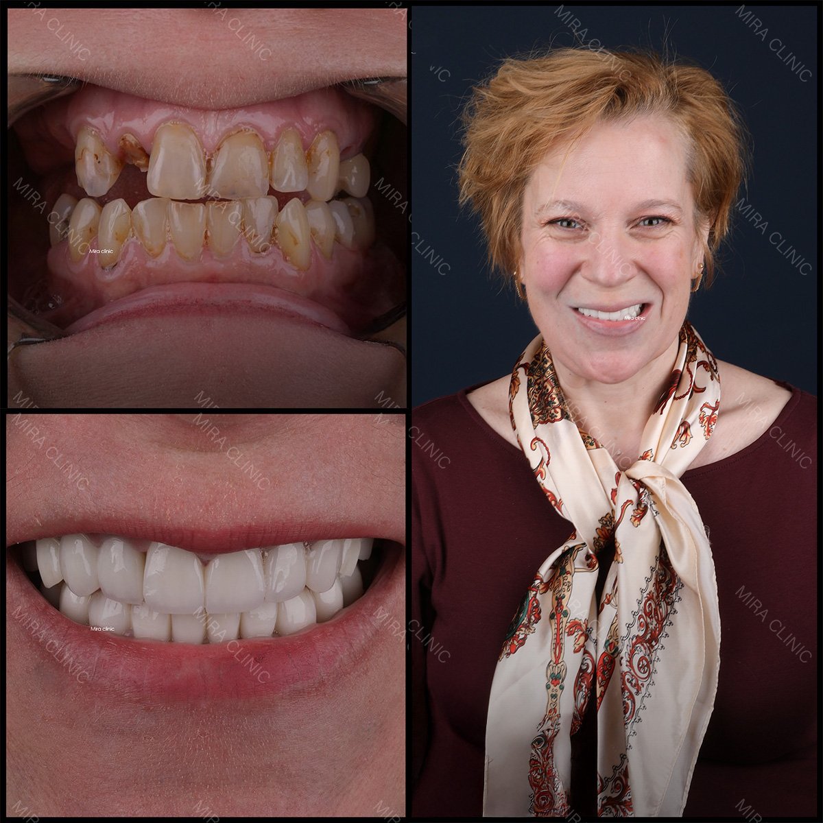 Before and after dental bone graft results at Mira Clinic, improved smile and healthy teeth