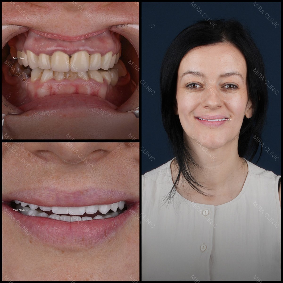 Bone graft and dental restoration results at Mira Clinic, improved smile and dental health