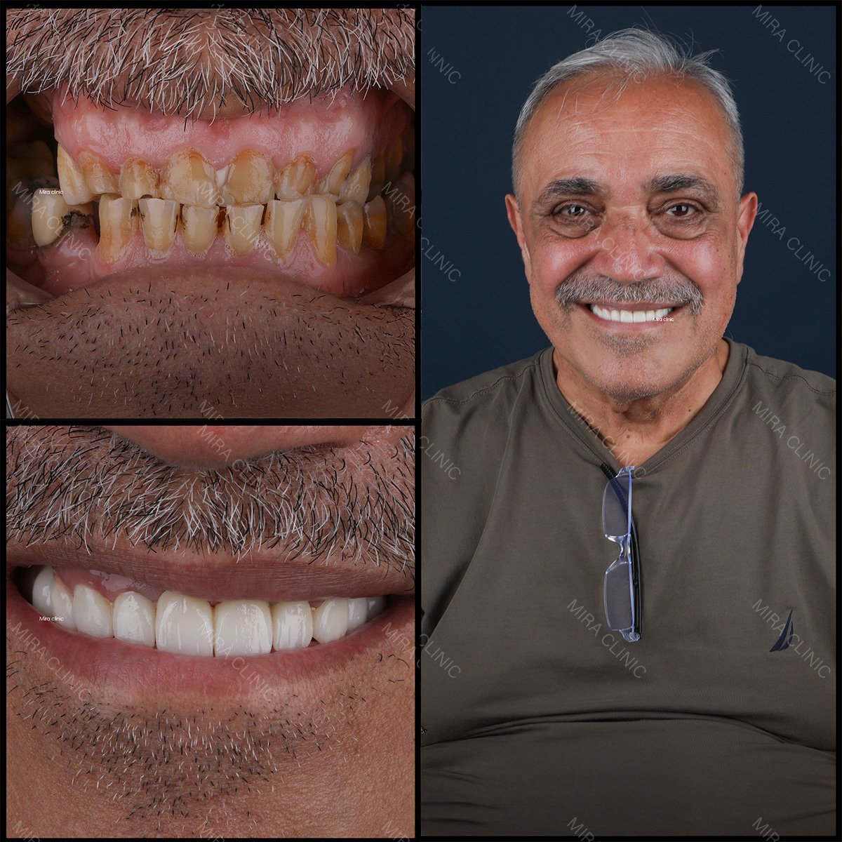 Before and after bone graft and dental restoration results at Mira Clinic, improved smile