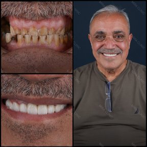 Small Bone Graft Package - photo 4