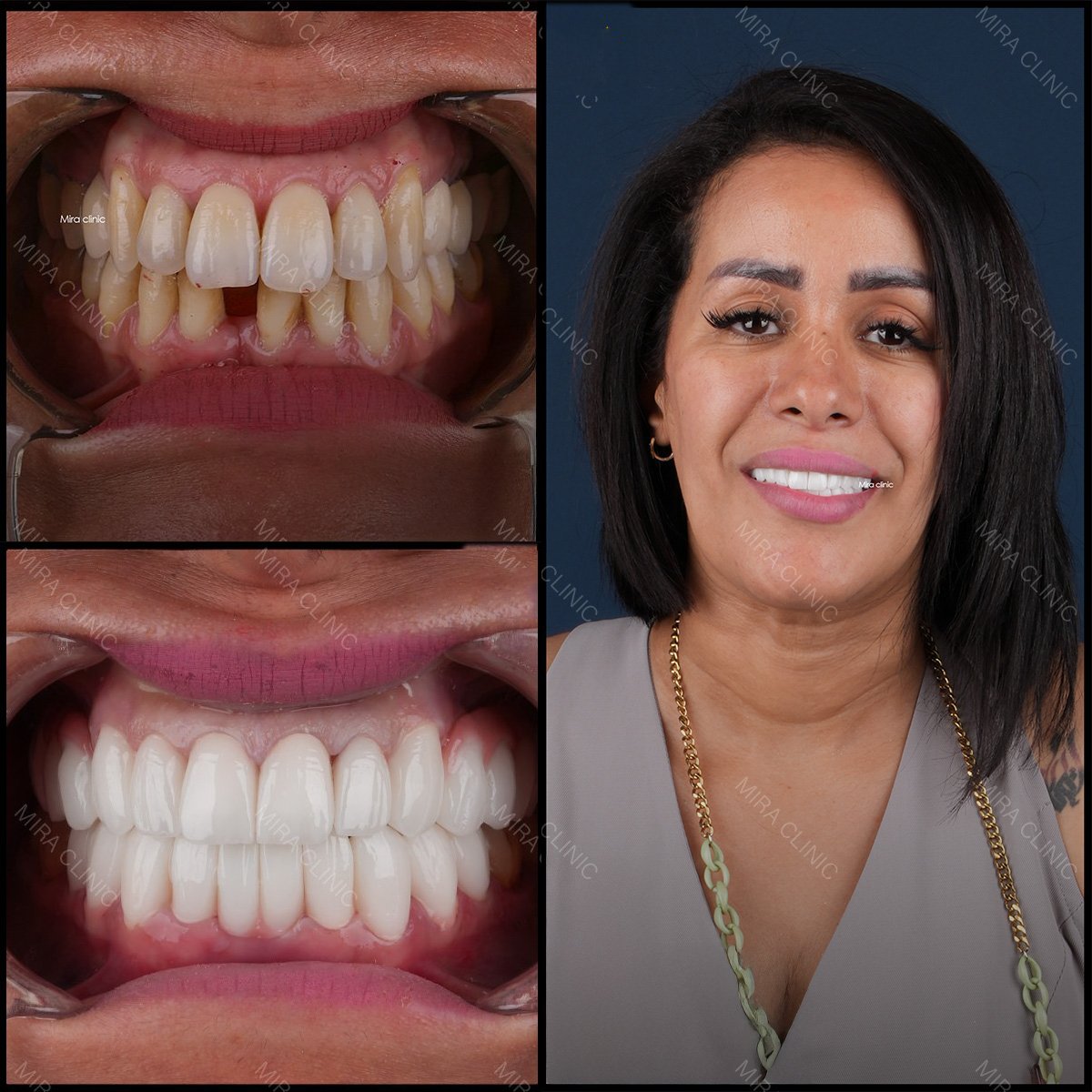 نتائج قبل وبعد زراعة العظم وترميم الأسنان في عيادة ميرا، ابتسامة محسنة