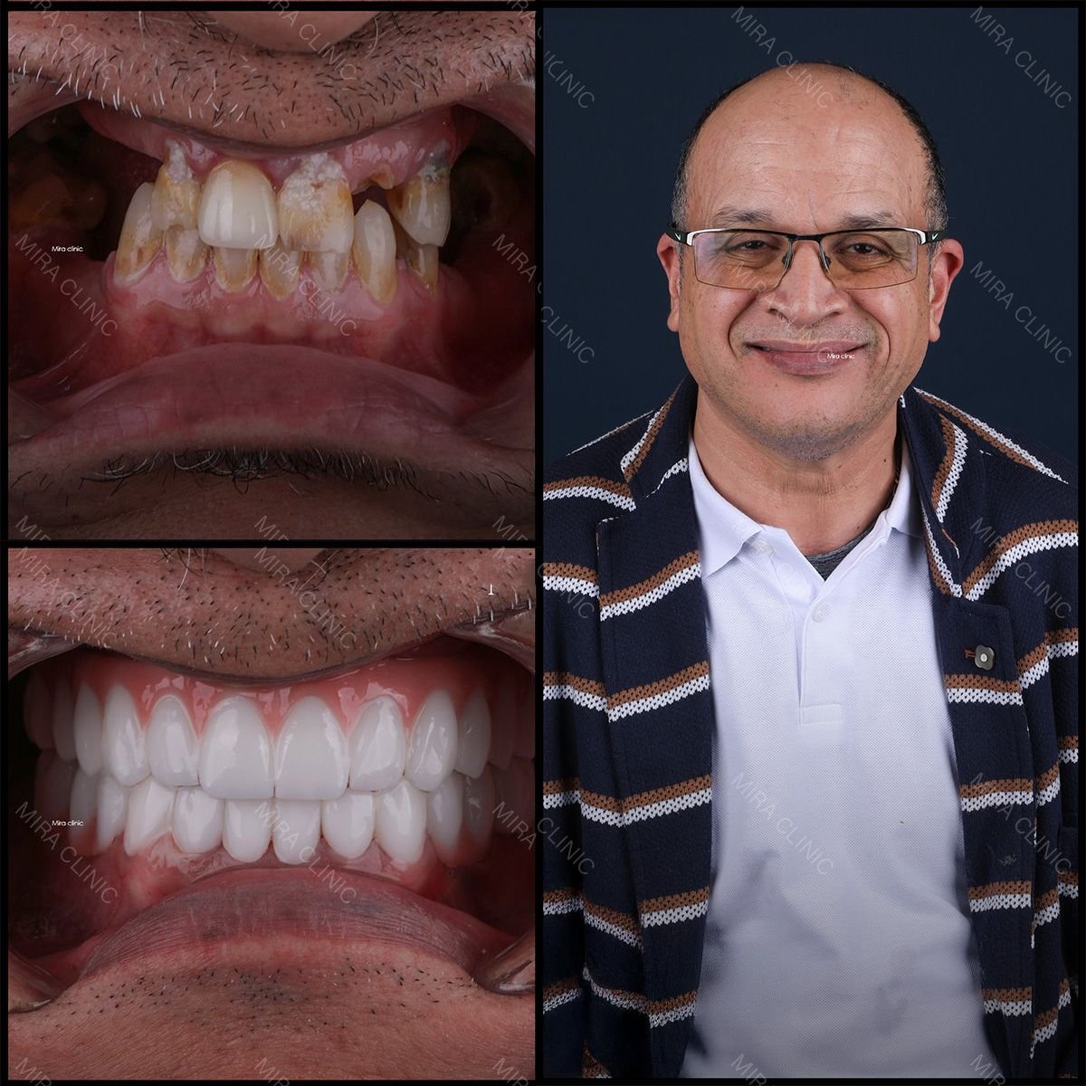 نتائج قبل وبعد زراعة الأسنان في عيادة ميرا، ابتسامة وأسنان صحية مستعادة