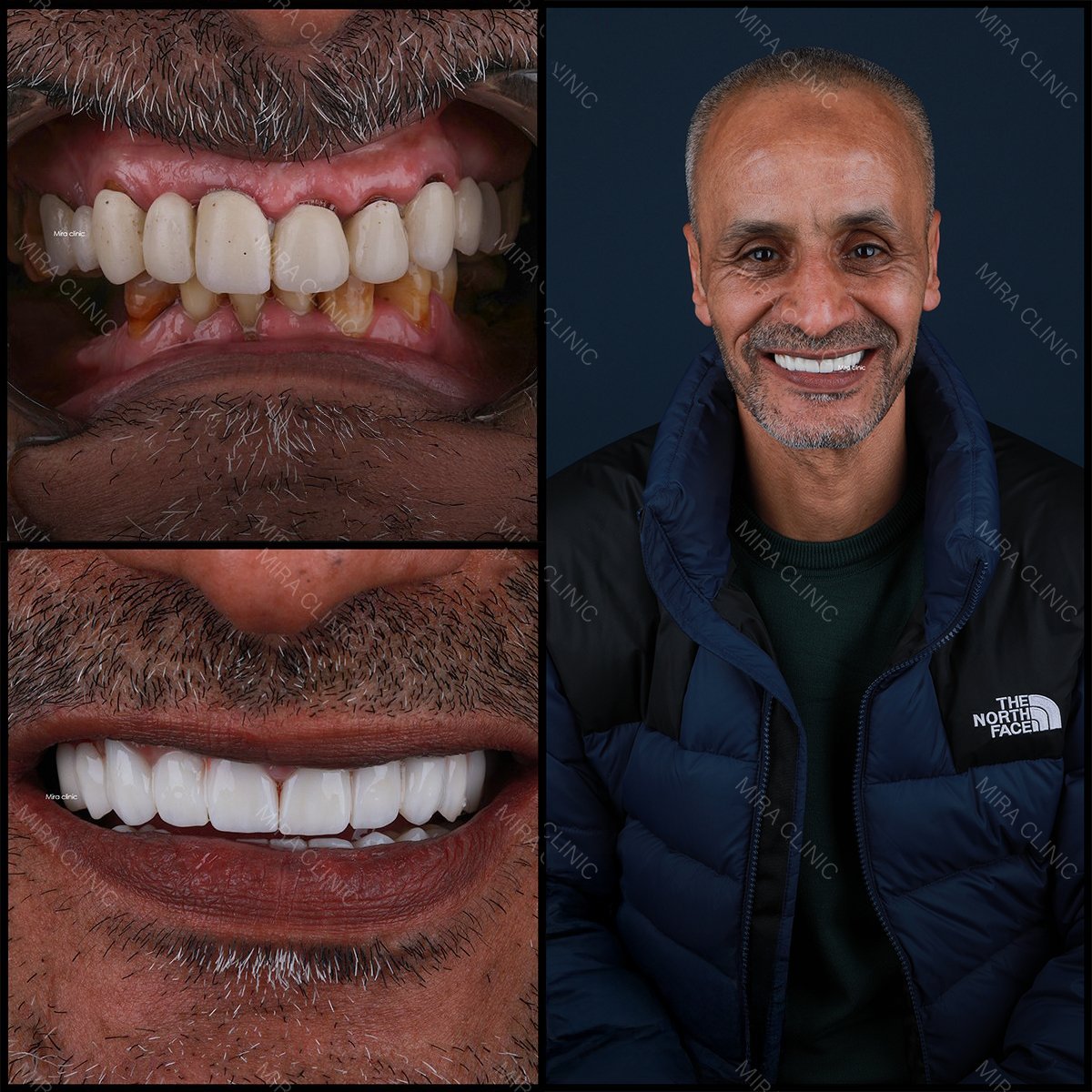 Smile makeover with dental veneers at Mira Clinic (Mira Clinic SAĞLIK TURİZM ŞİRKETİ) result