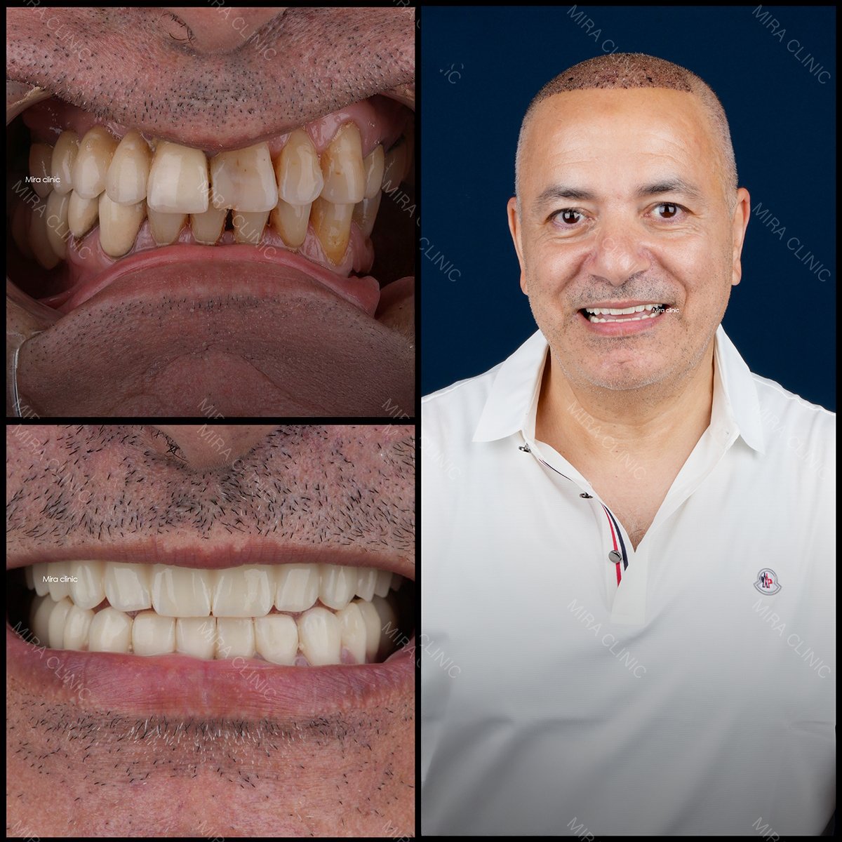 نتائج قبل وبعد عدسات الأسنان في عيادة ميرا، ابتسامة محسنة وأسنان أكثر بياضًا