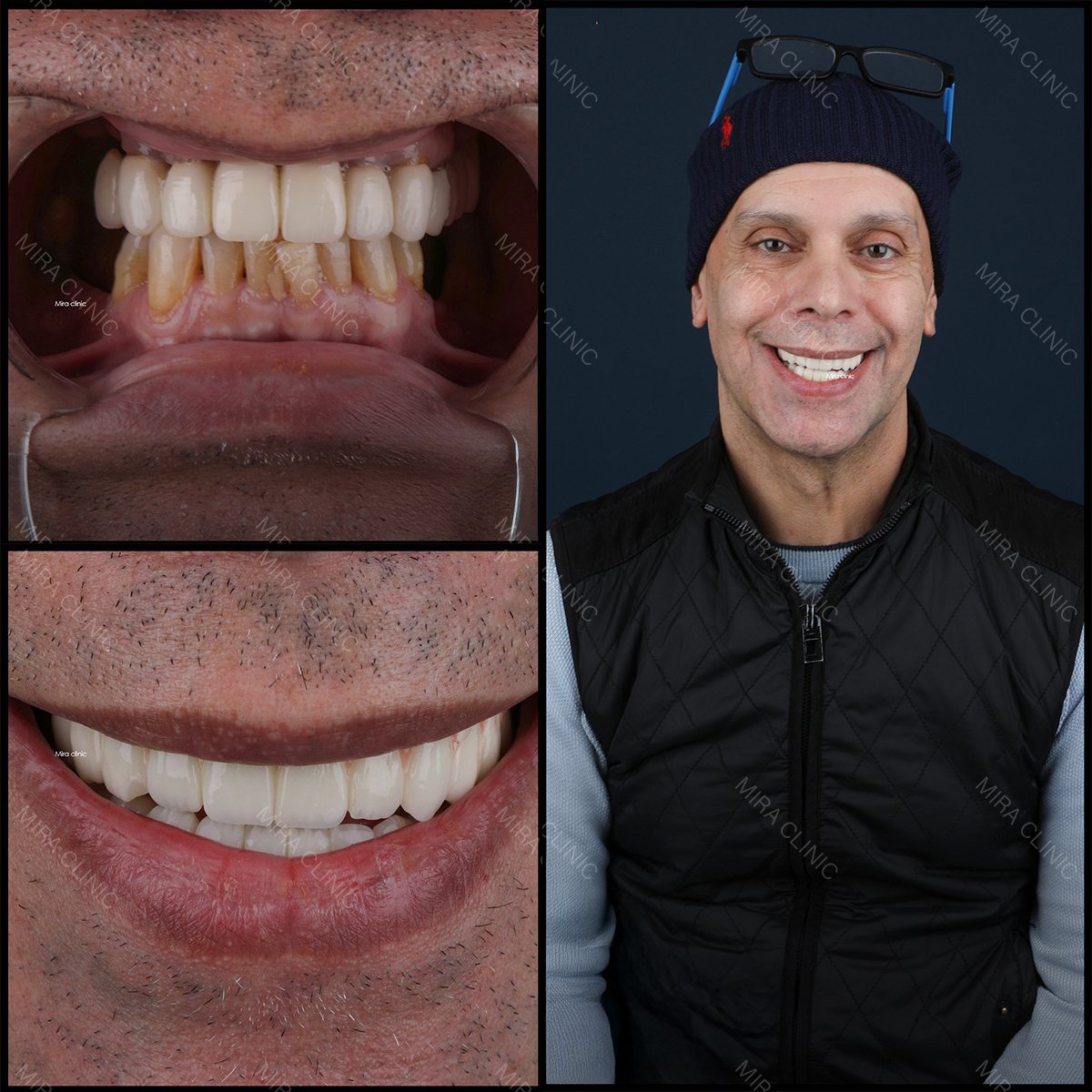 Before and after dental veneers results at Mira Clinic, improved smile and whiter teeth