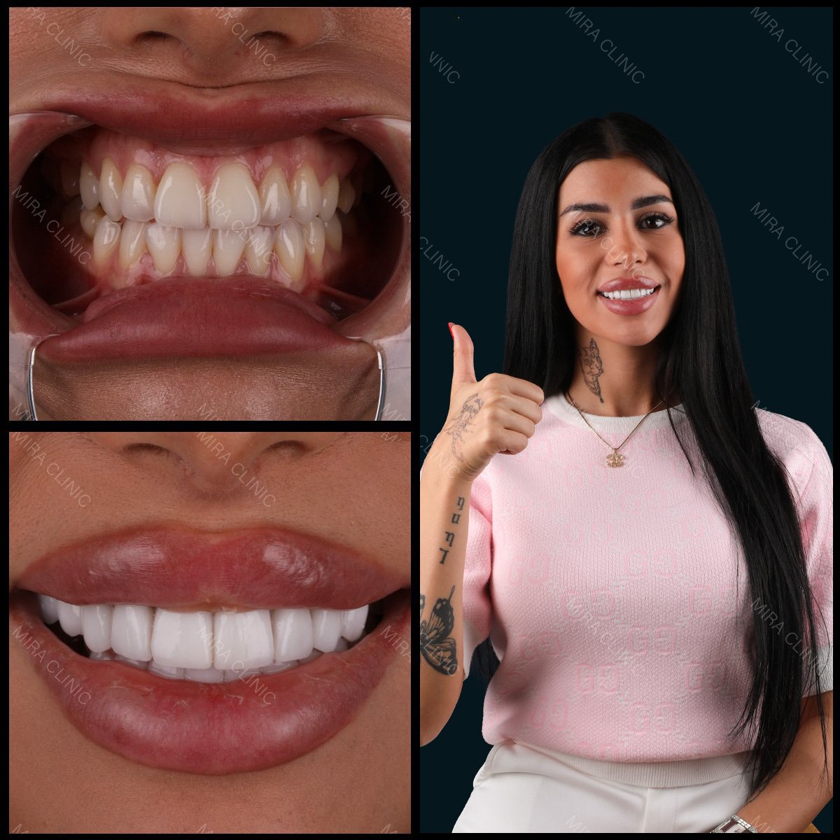 نتائج تركيب تيجان الزركونيا في عيادة ميرا، ابتسامة طبيعية وأسنان بيضاء