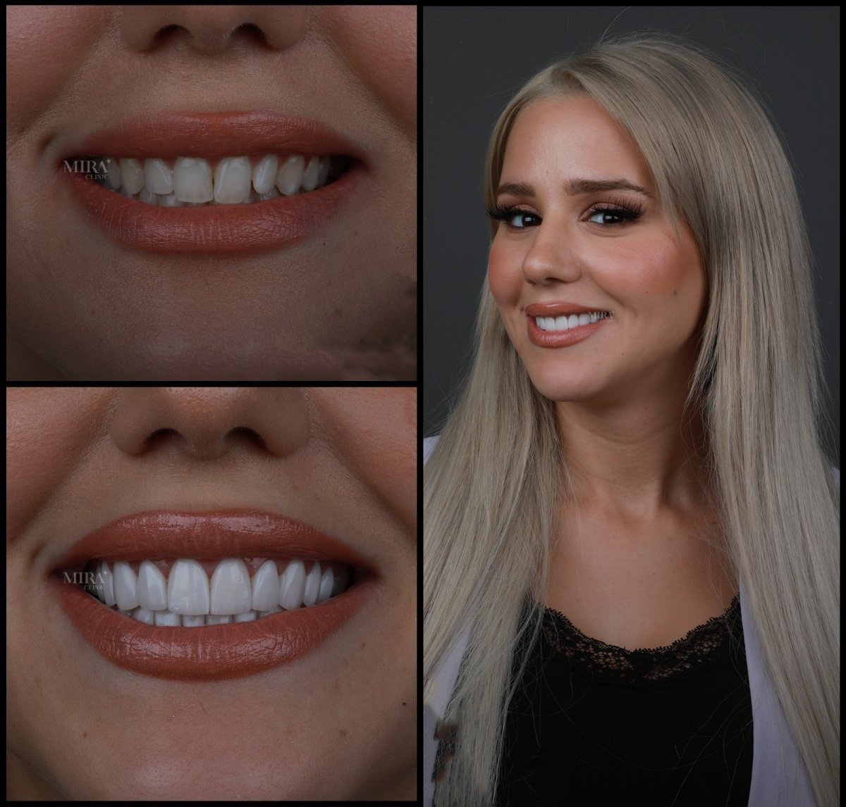 Resultados antes y después de coronas de zirconia en Mira Clinic, sonrisa natural