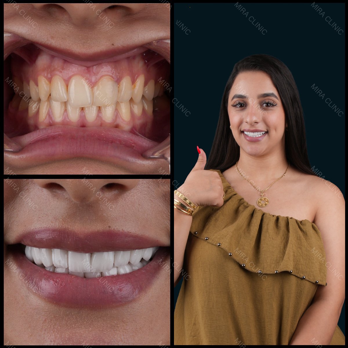 نتائج قبل وبعد تركيب تيجان الزركونيا في عيادة ميرا، ابتسامة أكثر بياضًا