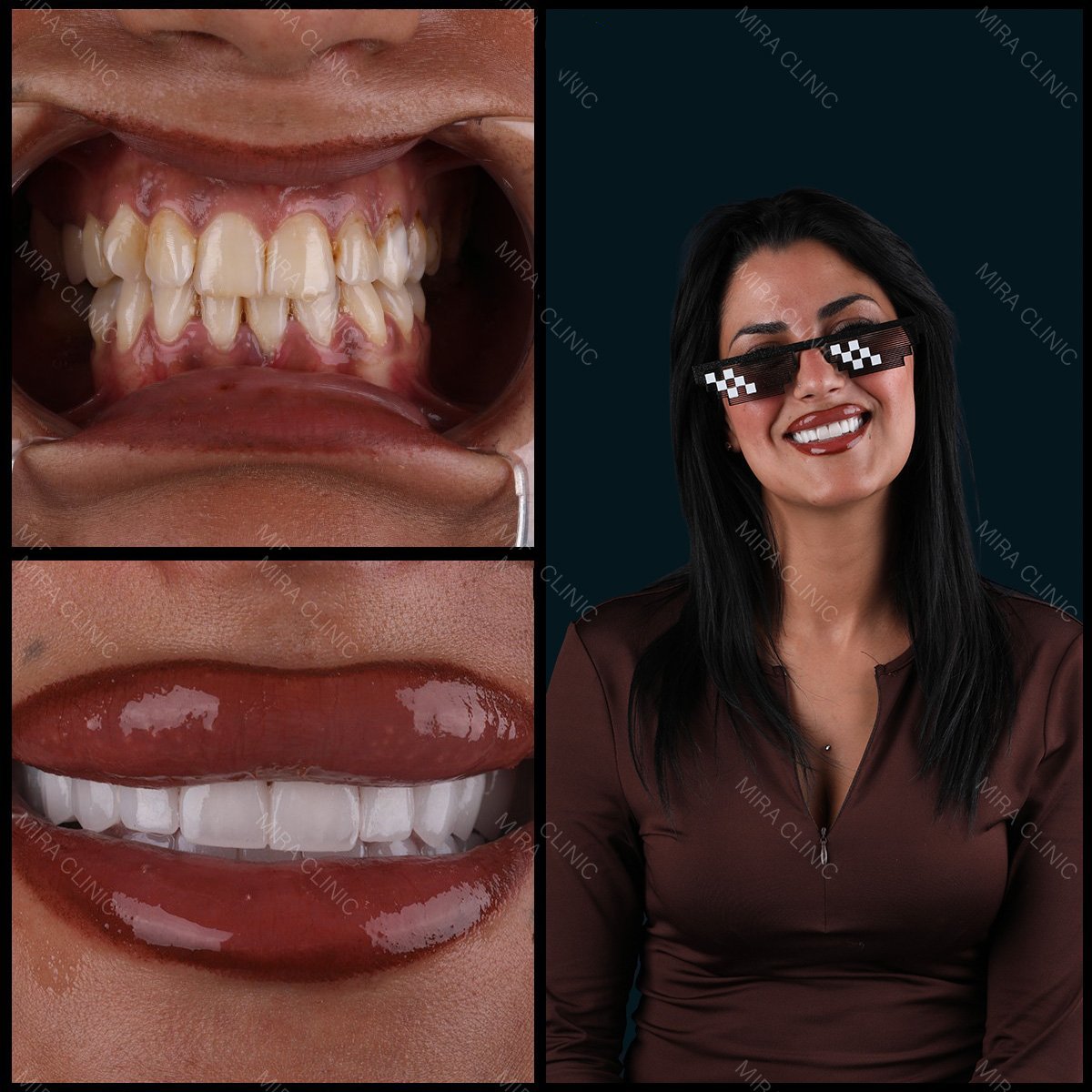 نتائج قبل وبعد تركيب تيجان الزركونيا في Mira Clinic، ابتسامة طبيعية