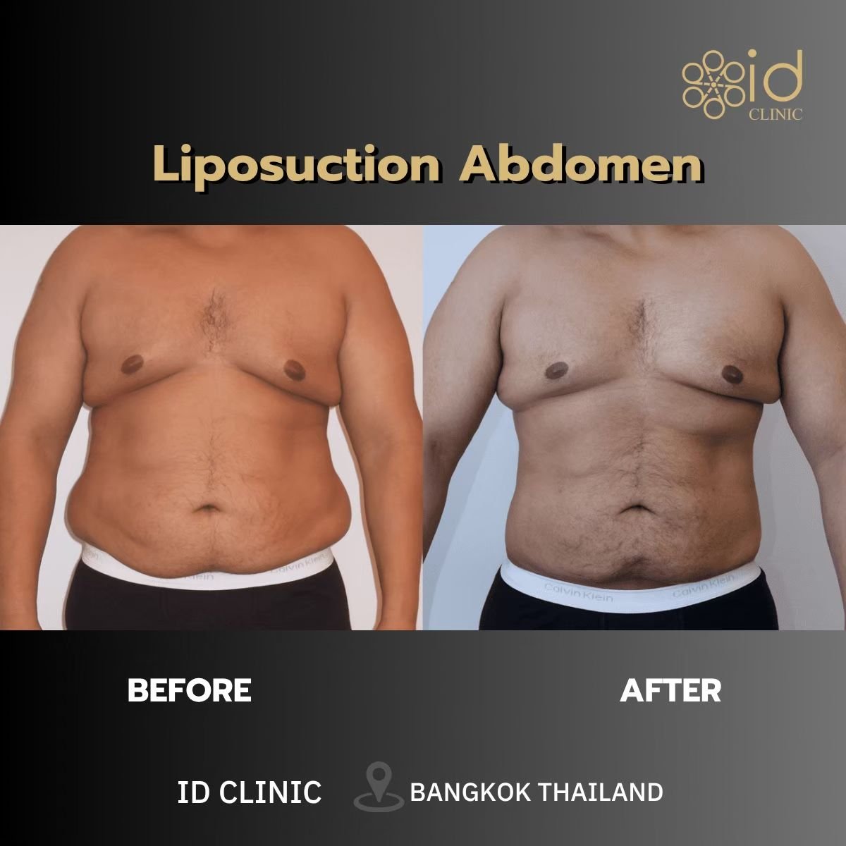 Before and after liposuction abdomen results at ID Clinic Bangkok, visible body contouring