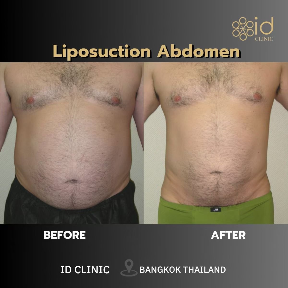 Before and after liposuction abdomen results at ID Clinic Bangkok, visible fat reduction