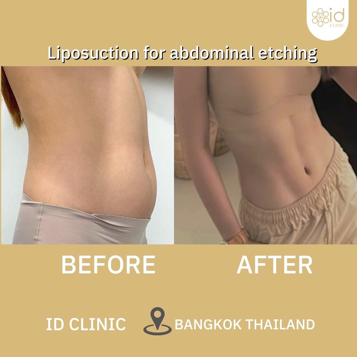 Antes y después de liposucción abdominal con marcación en ID Clinic Bangkok, abdomen definido