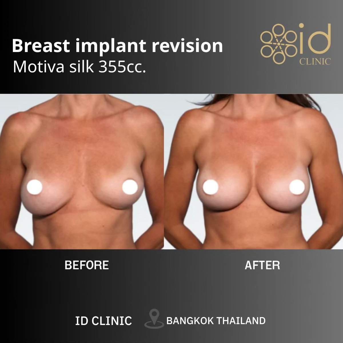 Before and after breast implant revision with Motiva 355cc at ID Clinic Bangkok results