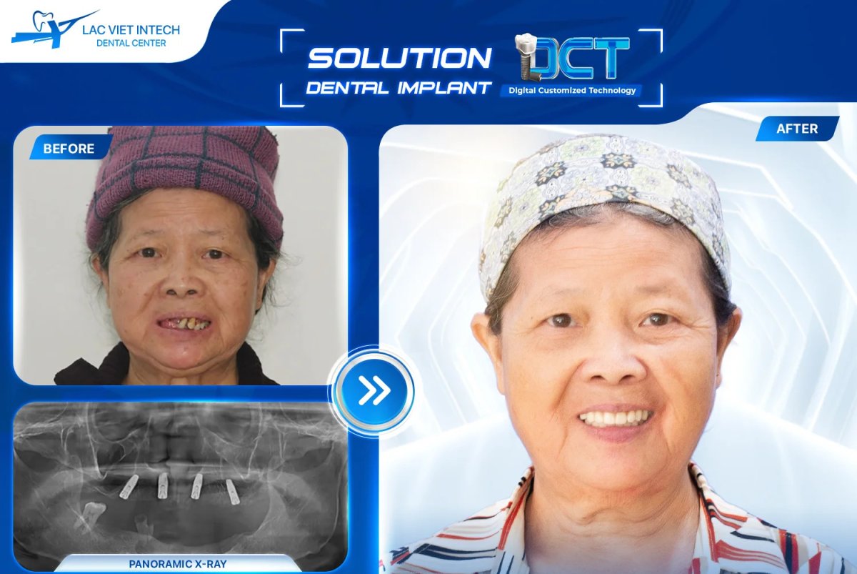 Efekty przed i po implantacji zębów w Lac Viet Intech, poprawiony uśmiech