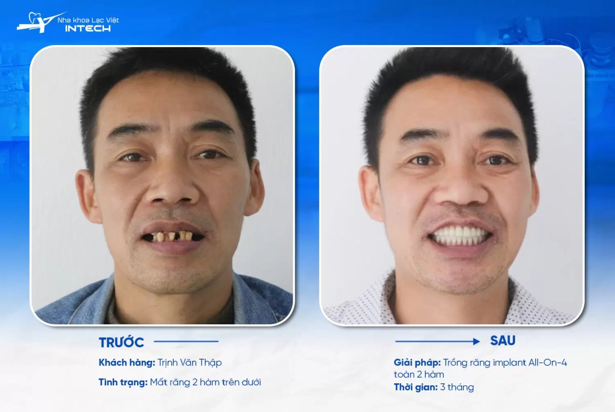 Résultat avant/après implants All-on-4 à la clinique INTECH – restauration du sourire