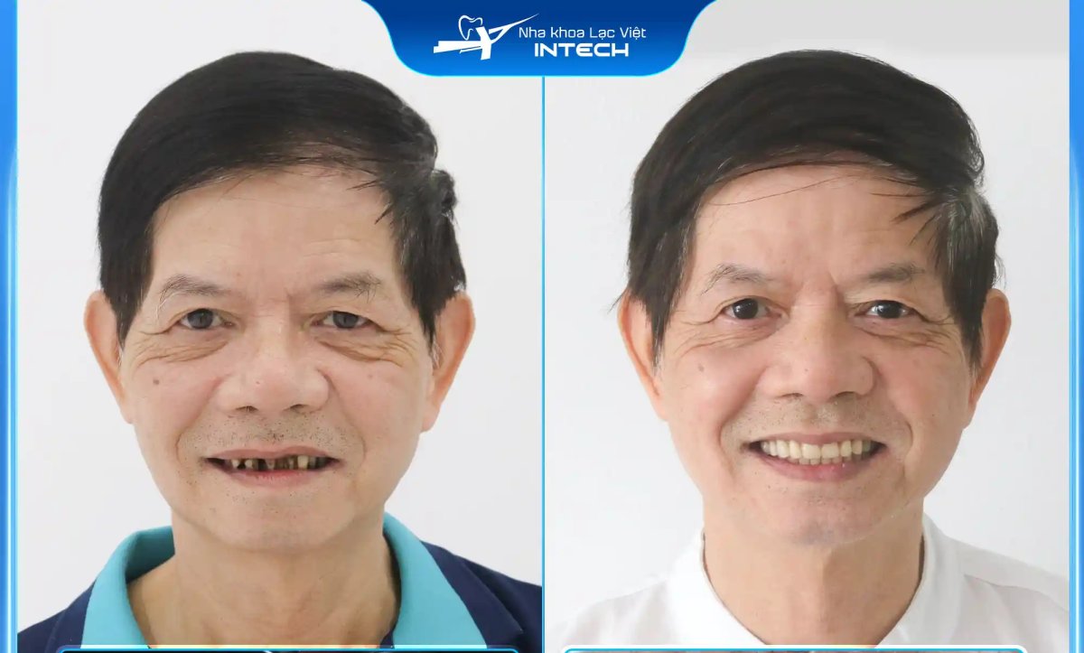 Before and after All-on-4 dental implants result at Intech Clinic – restored full smile