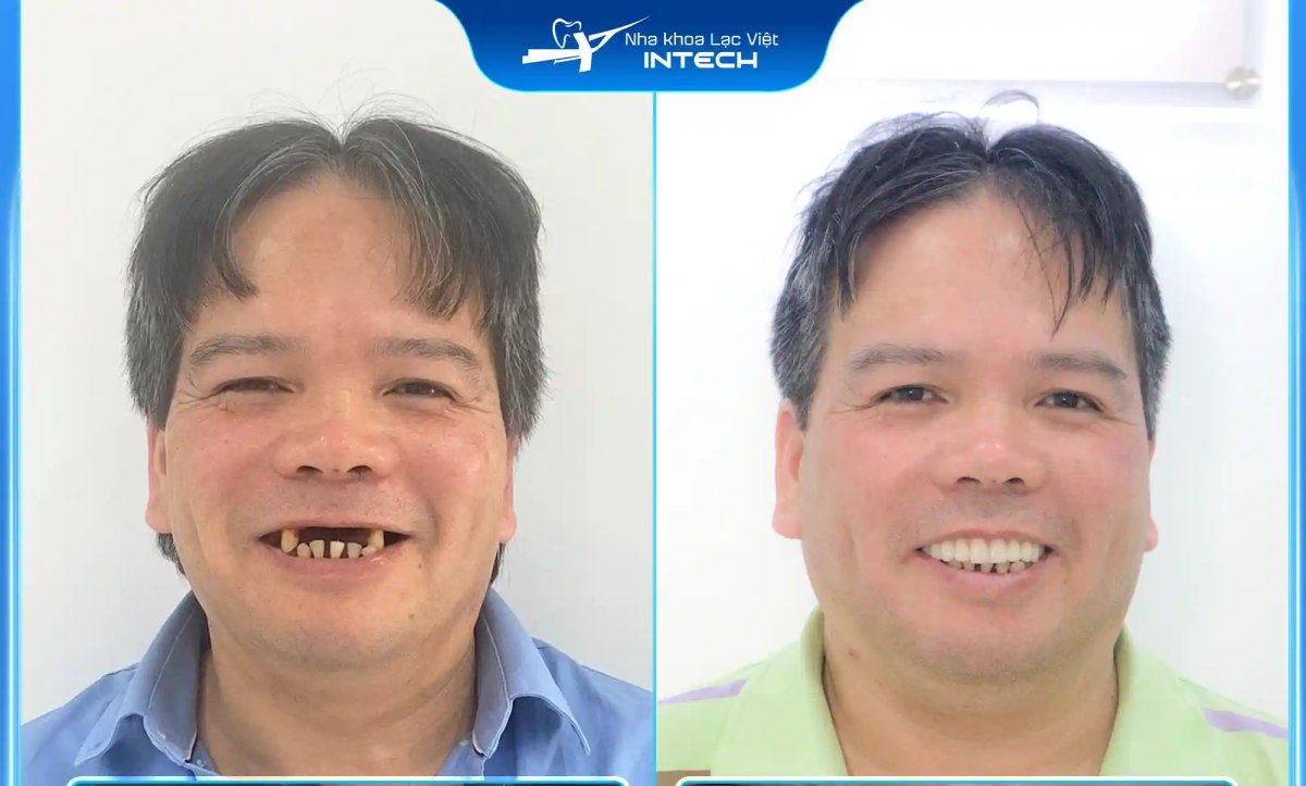 Before and after dental implants at Intech Clinic – restored smile and improved teeth result