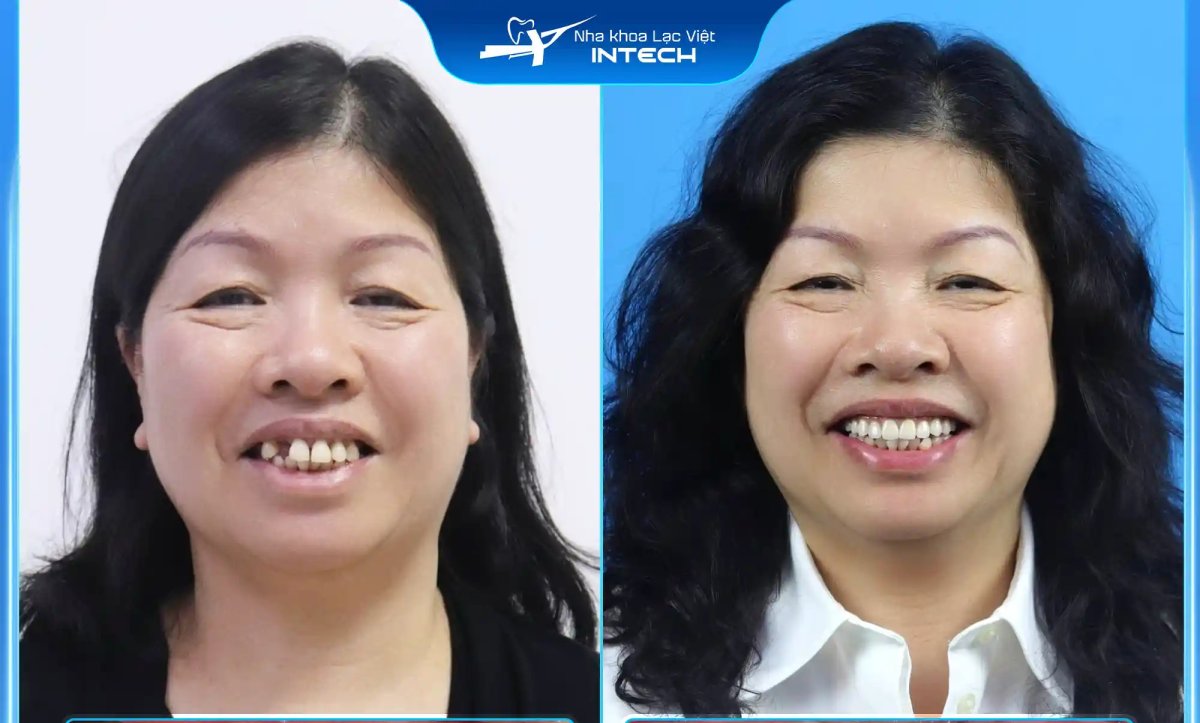 Before and after dental veneers result at INTECH Clinic – improved smile and aligned teeth