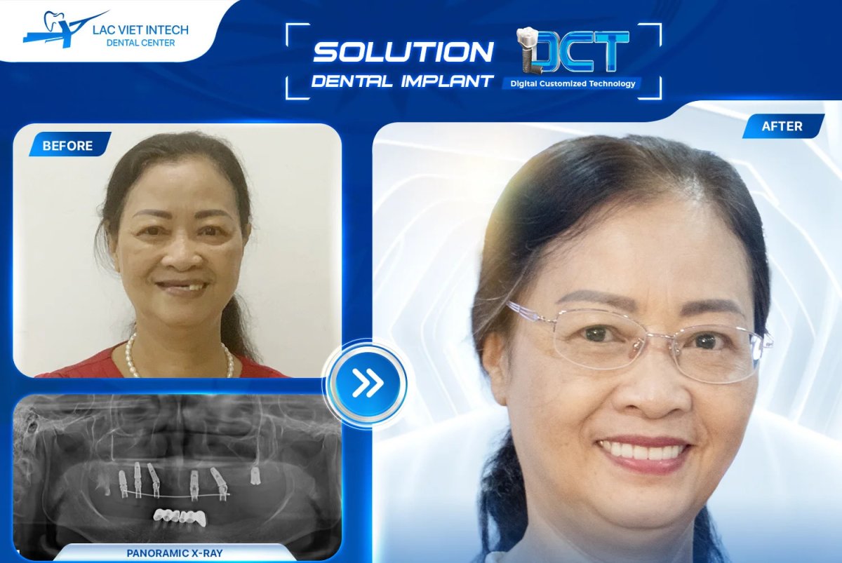Before and after dental implant with crown result at Lac Viet Intech Dental Center