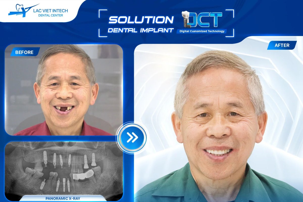 Resultado antes y después de implante dental con corona en Lac Viet Intech Dental Center