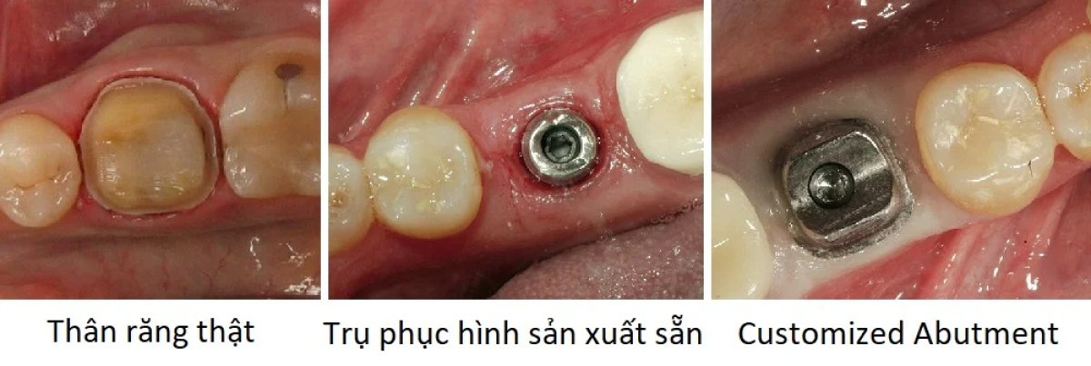 Étapes de l’implant dentaire avec pilier, résultat visible de la pose de l’implant