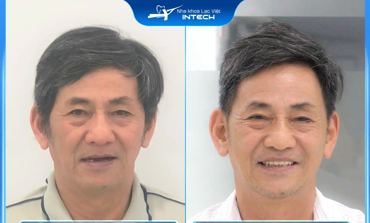 Résultats avant/après Hollywood Smile chez Nha Khoa Lạc Việt Intech – sourire amélioré