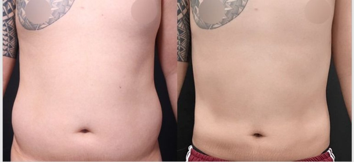 Resultados de liposucción antes y después en VG Plastic Surgery – mejora del contorno abdominal