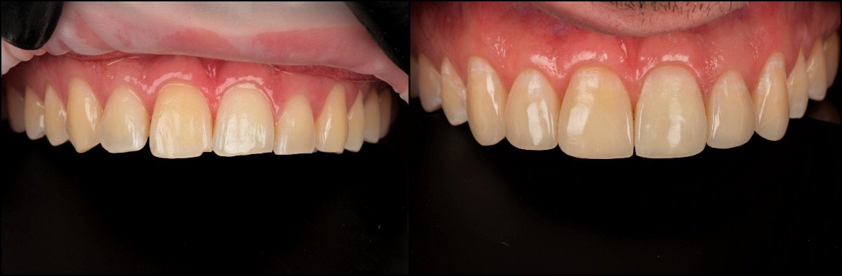 До та після естетичної композитної пломби в RIKOTA Dental Clinic, покращений результат усмішки