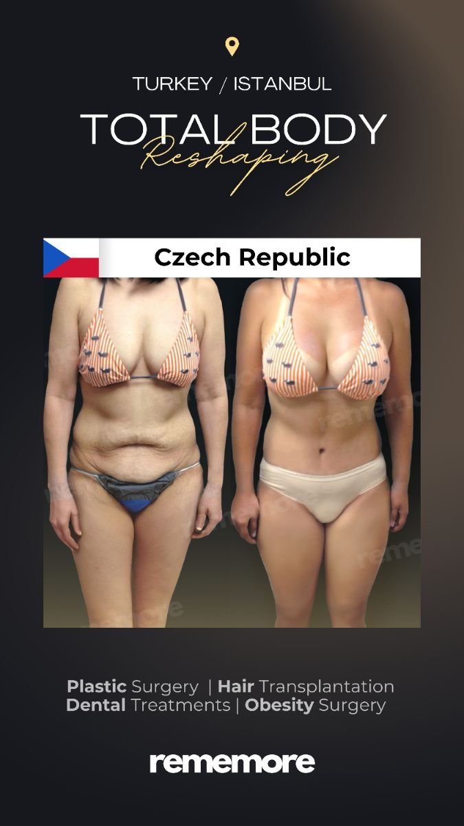 Before and after post-bariatric plastic surgery results at Memorial Şişli Hospital, body contouring