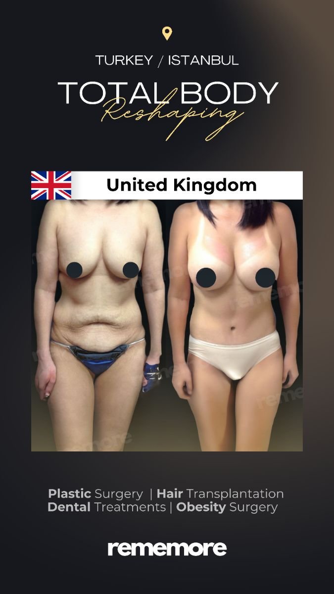Before and after post-bariatric plastic surgery results at Memorial Şişli Hospital, body contouring