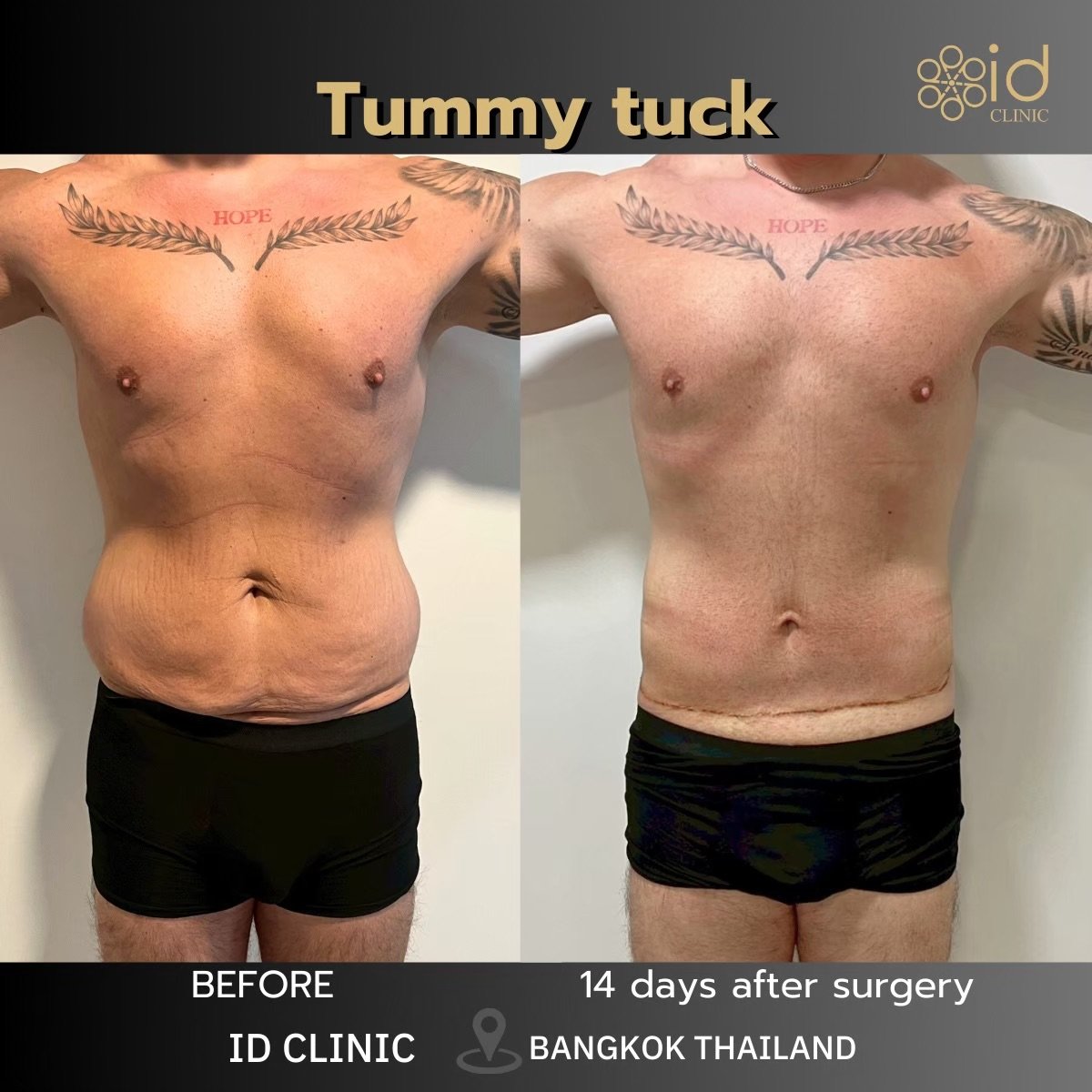 Before and after tummy tuck results at ID Clinic Bangkok, flatter abdomen after 14 days