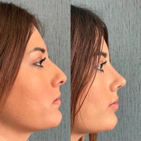 Premium Rhinoplasty (nose job) All Included - photo 5