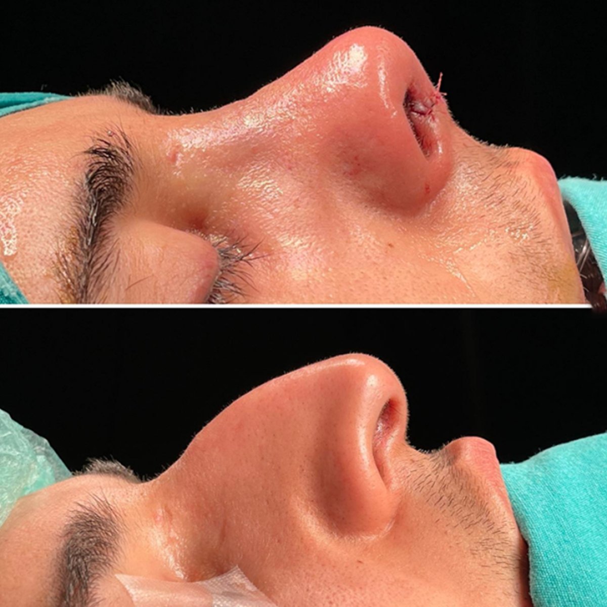 Resultados de rinoplastia antes y después en Lokman Hekim Istanbul Hospital, forma de nariz mejorada