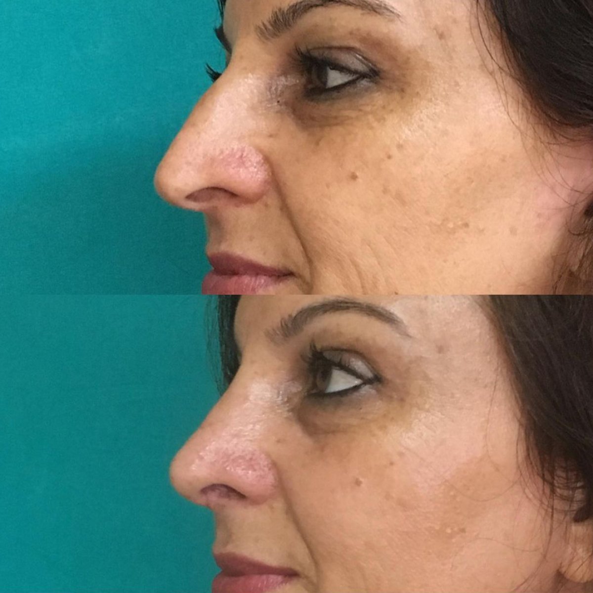 نتائج عملية تجميل الأنف قبل وبعد في مستشفى لوكمان حكيم إسطنبول، إعادة تشكيل الأنف