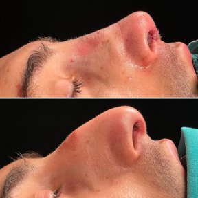 Premium Rhinoplasty (nose job) All Included - photo 4