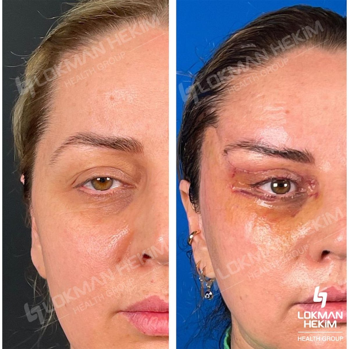 نتائج قبل وبعد عملية Fox Eye Lift في مستشفى لوكمان حكيم اسطنبول، شد الجفن