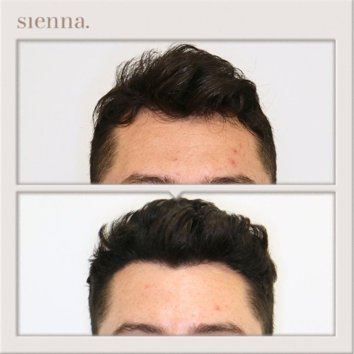 نتائج زراعة الشعر FUE قبل وبعد في Sienna Clinic – كثافة شعر محسنة