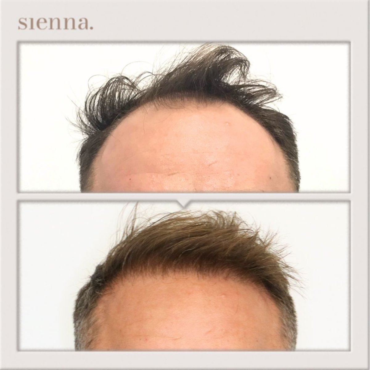 نتائج زراعة الشعر FUE قبل وبعد في Sienna Clinic مع استعادة خط الشعر