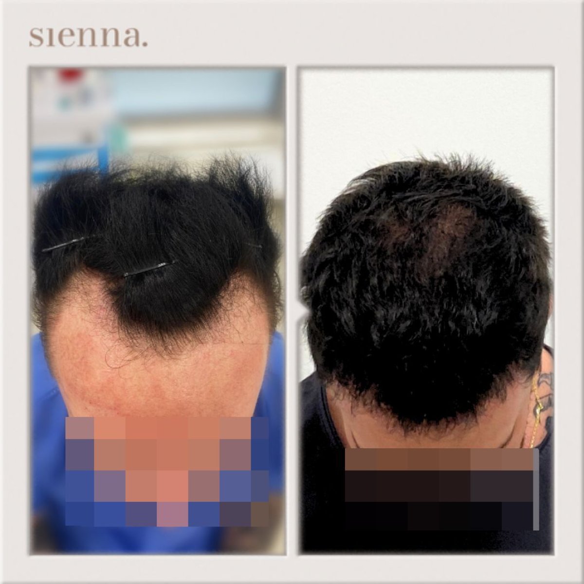 نتائج زراعة الشعر FUE قبل وبعد في عيادة Sienna مع كثافة شعر محسنة