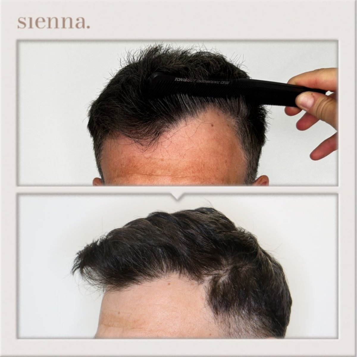 نتائج زراعة الشعر FUE قبل وبعد في عيادة Sienna مع خط شعر أكثر كثافة