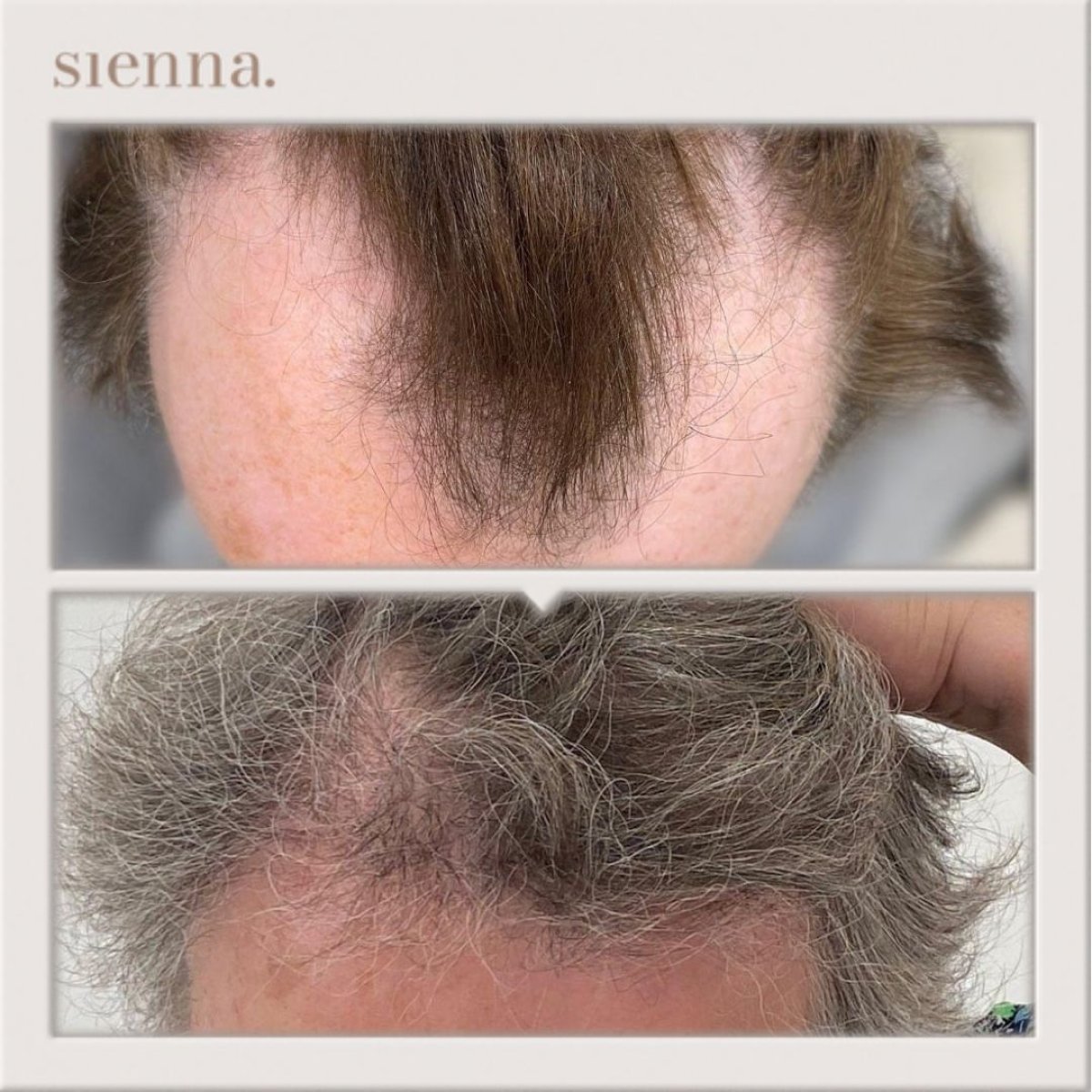 نتائج زراعة الشعر FUE قبل وبعد في عيادة Sienna، كثافة شعر محسنة